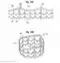 Fig. 12 - Systems for quickly delivering a prosthetic heart valve