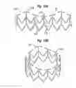 Fig. 13 - Systems for quickly delivering a prosthetic heart valve