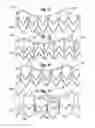 Fig. 14 - Systems for quickly delivering a prosthetic heart valve