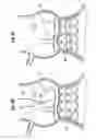 Fig. 06 - Rapid deployment methods for prosthetic heart valves