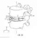 Fig. 02 - Expandable intervertebral implant