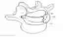 Fig. 01 - In-situ formed intervertebral fusion device and method