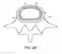 Fig. 04 - In-situ formed intervertebral fusion device and method