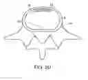 Fig. 06 - In-situ formed intervertebral fusion device and method