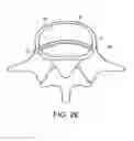 Fig. 07 - In-situ formed intervertebral fusion device and method
