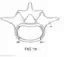Fig. 28 - In-situ formed intervertebral fusion device and method