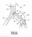 Fig. 08 - Treatment kit, treatment device, and associated method of production