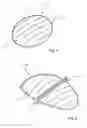 Fig. 02 - Intragastric balloon