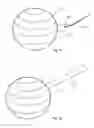 Fig. 07 - Intragastric balloon
