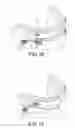 Fig. 09 - MANDIBULAR ADVANCEMENT DEVICE, AND A METHOD AND KIT FOR PREPARING SAID DEVICE