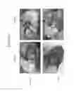 Fig. 07 - Joint repair using mesenchymal stem cells