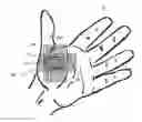 Fig. 01 - Expandable amnion membrane for treating non-healing wounds
