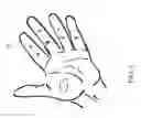 Fig. 03 - Expandable amnion membrane for treating non-healing wounds