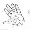 Fig. 04 - Expandable amnion membrane for treating non-healing wounds
