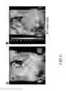 Fig. 08 - Superparamagnetic nanoparticles as a contrast agent for magnetic resonance imaging (MRI) of magnetic susceptibility (T2*)