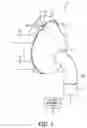 Fig. 02 - Leak correction for a patient interface device