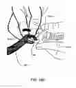 Fig. 147 - Patient interface