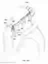 Fig. 90 - Patient interface