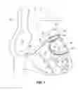 Fig. 02 - Pacing lead for a left cavity of the heart, implanted in the coronary system