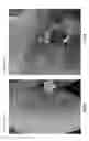 Fig. 41 - METHODS FOR DETECTION AND DIAGNOSIS OF A LYMPHOID MALIGNANCY USING HIGH THROUGHPUT SEQUENCING