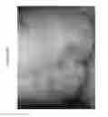 Fig. 43 - METHODS FOR DETECTION AND DIAGNOSIS OF A LYMPHOID MALIGNANCY USING HIGH THROUGHPUT SEQUENCING