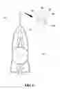 Fig. 05 - Catheter using optical fiber and camera