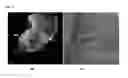 Fig. 07 - Method and Apparatus for Image Fusion Based Planning of C-Arm Angulation for Structural Heart Disease