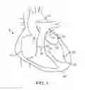 Fig. 02 - SYSTEM AND METHOD FOR TRANSAPICAL ACCESS AND CLOSURE