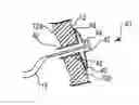 Fig. 01 - Collapsible tissue anchor device and method