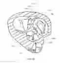 Fig. 22 - Medical kit for constricting tissue or a bodily orifice, for example, a mitral valve