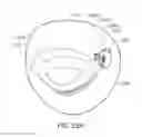 Fig. 35 - Medical kit for constricting tissue or a bodily orifice, for example, a mitral valve