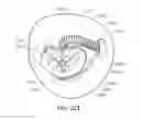 Fig. 43 - Medical kit for constricting tissue or a bodily orifice, for example, a mitral valve