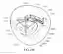 Fig. 45 - Medical kit for constricting tissue or a bodily orifice, for example, a mitral valve