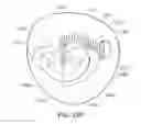 Fig. 50 - Medical kit for constricting tissue or a bodily orifice, for example, a mitral valve