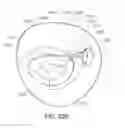Fig. 52 - Medical kit for constricting tissue or a bodily orifice, for example, a mitral valve