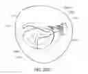 Fig. 53 - Medical kit for constricting tissue or a bodily orifice, for example, a mitral valve