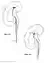 Fig. 06 - Methods and Systems for Capturing and Removing Urinary Stones from Body Cavities