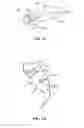 Fig. 06 - Implant system and method for stabilization of a sacro-iliac joint