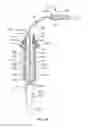 Fig. 07 - Implant system and method for stabilization of a sacro-iliac joint