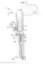 Fig. 02 - Instruments and methods for tensioning a spinal tether