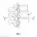Fig. 02 - DEVICE FOR TREATMENT OR EVACUATION OF INTERVERTEBRAL DISC