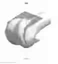 Fig. 35 - Patient specific implant technology