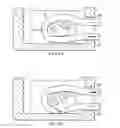 Fig. 02 - Method for soft tissue repair with free floating suture locking member