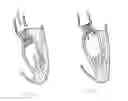 Fig. 22 - Methods and apparatus for endovascularly replacing a patient's heart valve