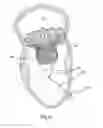 Fig. 07 - Adjustable tether and epicardial pad system for prosthetic heart valve