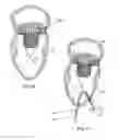 Fig. 09 - Adjustable tether and epicardial pad system for prosthetic heart valve