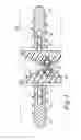 Fig. 02 - Prosthesis for the restoration of a joint between two bones, and ancillary tool for the assembly thereof