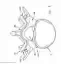 Fig. 06 - Multiple facet joint replacement