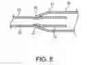Fig. 09 - Telescoping ureteral stent