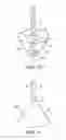 Fig. 11 - Telescoping ureteral stent